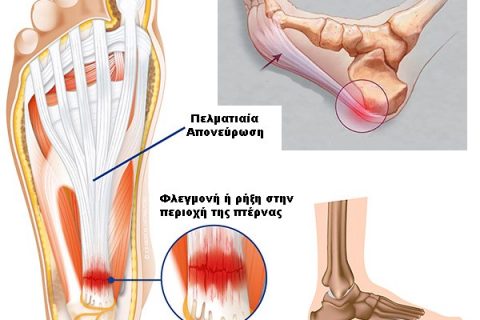 Πελματιαία απονευρωσίτιδα