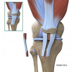 Πρόσθιος Χιαστός Σύνδεσμος (ACL) | Life Ergo