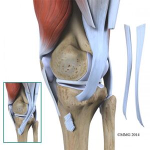 Πρόσθιος Χιαστός Σύνδεσμος (ACL) | Life Ergo